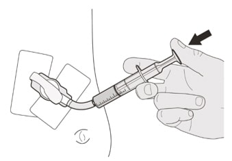 Flush the gastrostomy tube with 10 mL to 20 mL of water right after giving the prescribed dose of Evrysdi .image