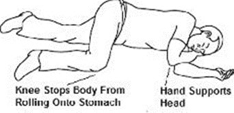 Move the person on their side (recovery position) after giving Kloxxado nasal spray.image