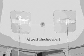 Use a different site(s) from the last time you infused Empaveli. If there are multiple infusion sites, they should be at least 3 inches apart. Change (rotate) infusion sites in between each infusion.image