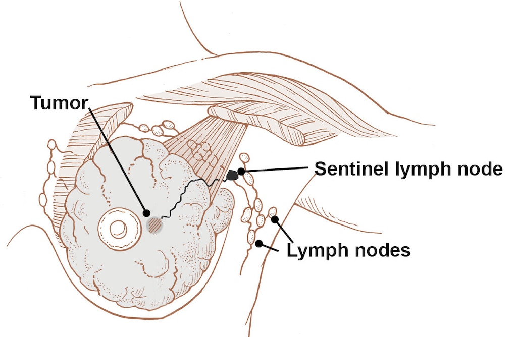Lymph nodes in the breast