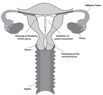 Image of Mirena in place in the uterus.