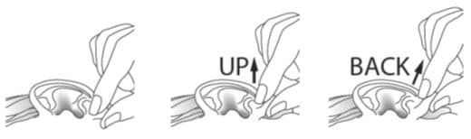 Gently pull the earlobe upward and backward to allow drops to enter the ear canal image.