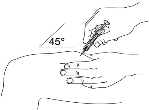 Do not pull back on the plunger at any time. Use the other hand to gently pinch the cleaned area of skin. Hold firmly. Use a quick, dart-like motion to insert the needle into the pinched skin at about a 45-degree angle. image