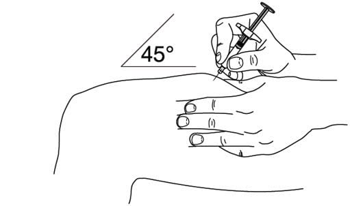 Step 5: Inject Stelara.  Hold the barrel of the syringe in one hand, between the thumb and index fingers. Do not pull back on the plunger at any time. Use the other hand to gently pinch the cleaned area of skin. Hold firmly. Use a quick, dart-like motion to insert the needle into the pinched skin at about a 45-degree angle. image