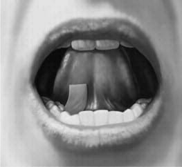 Place the Suboxone sublingual film under your tongue, close to the base either to the left or right of the center. image