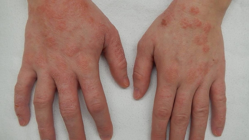 Dermatitis Herpetiformis