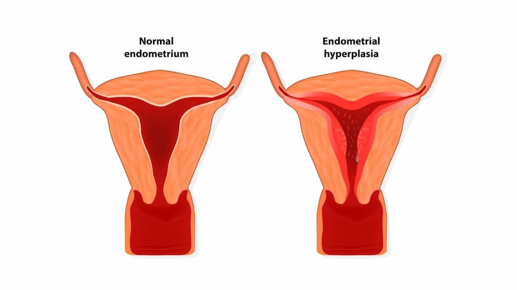 Endometrial Hyperplasia