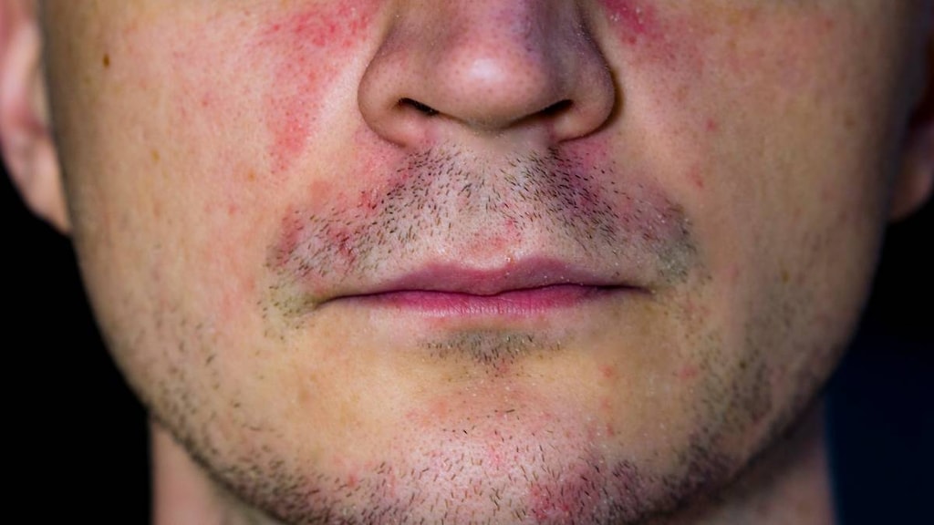 Perioral dermatitis