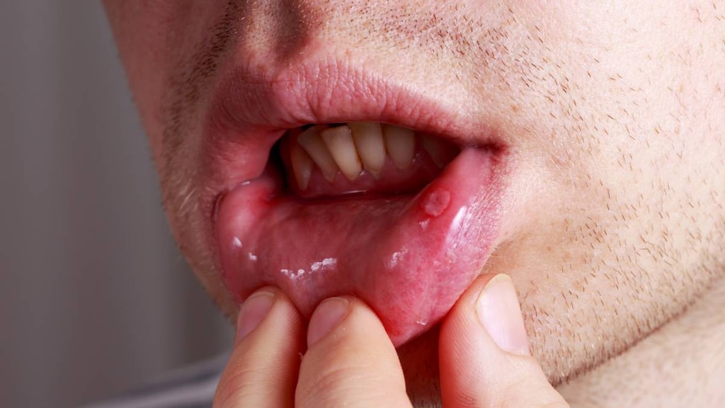 aphthous stomatitis