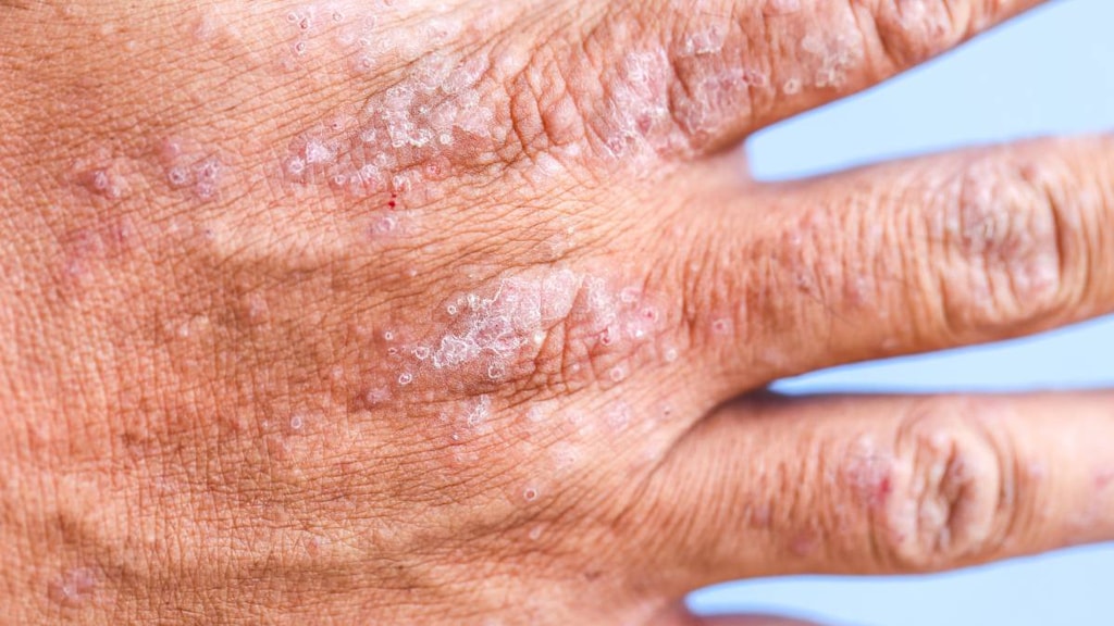 Hand with Atopic Dermatitis