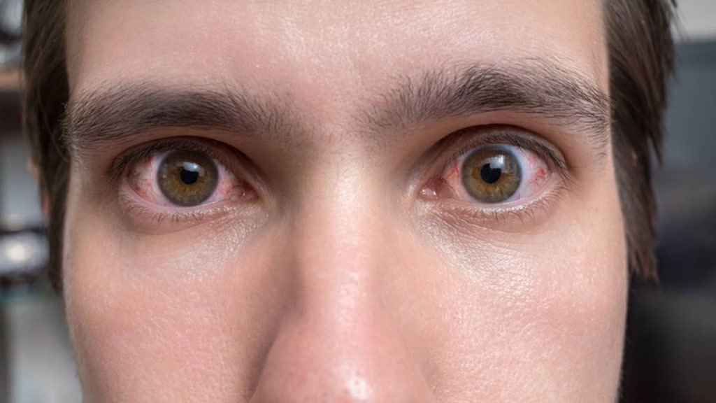 Man with conjunctivitis