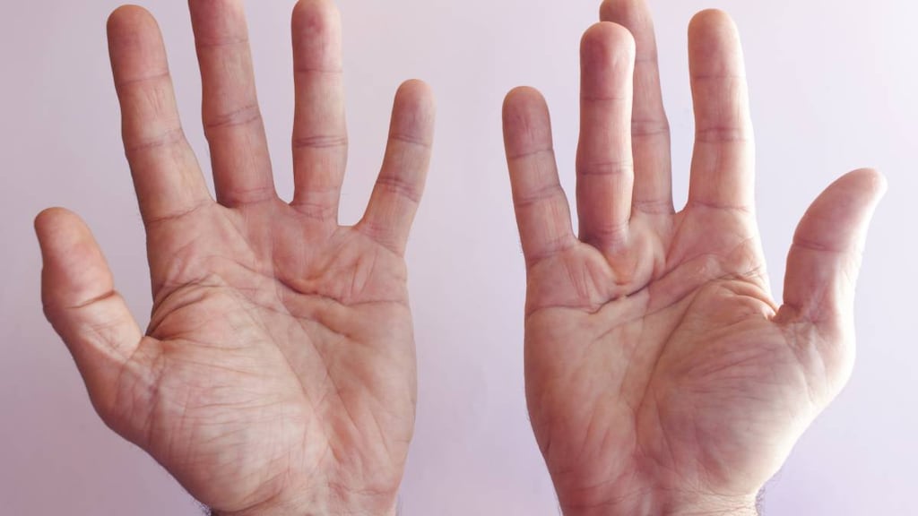 Hands with Dupuytren's Contracture