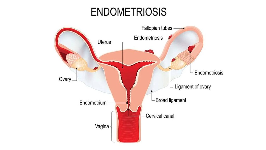 Endometriosis illustration