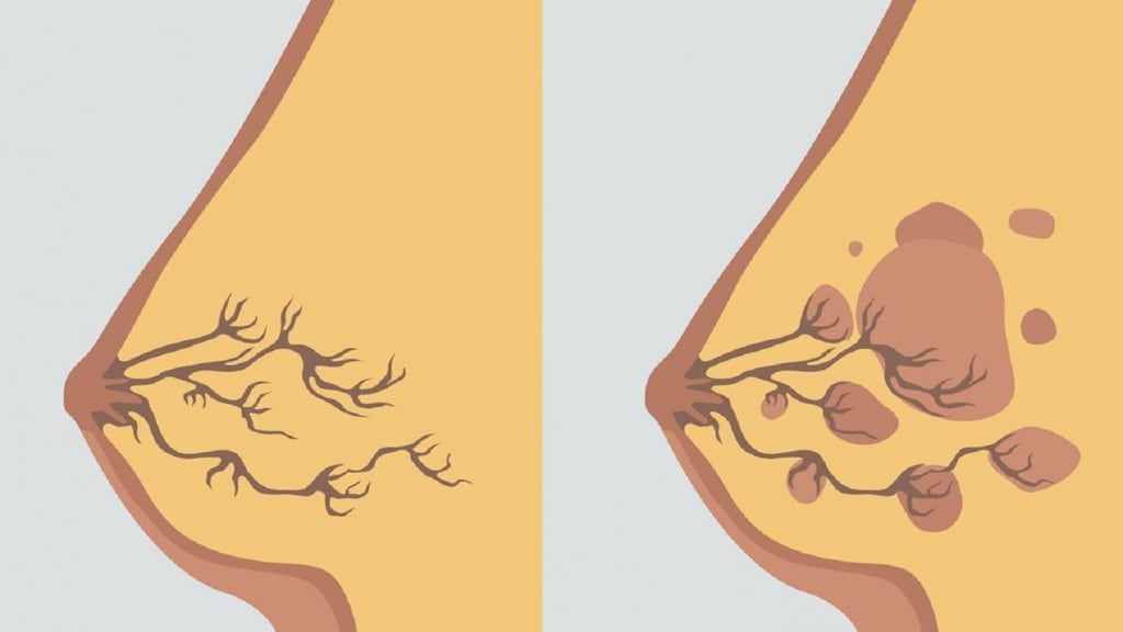 Illustration of Fibrocystic Breast Disease