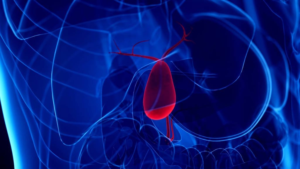 Cholelithiasis with Acute Cholecystitis