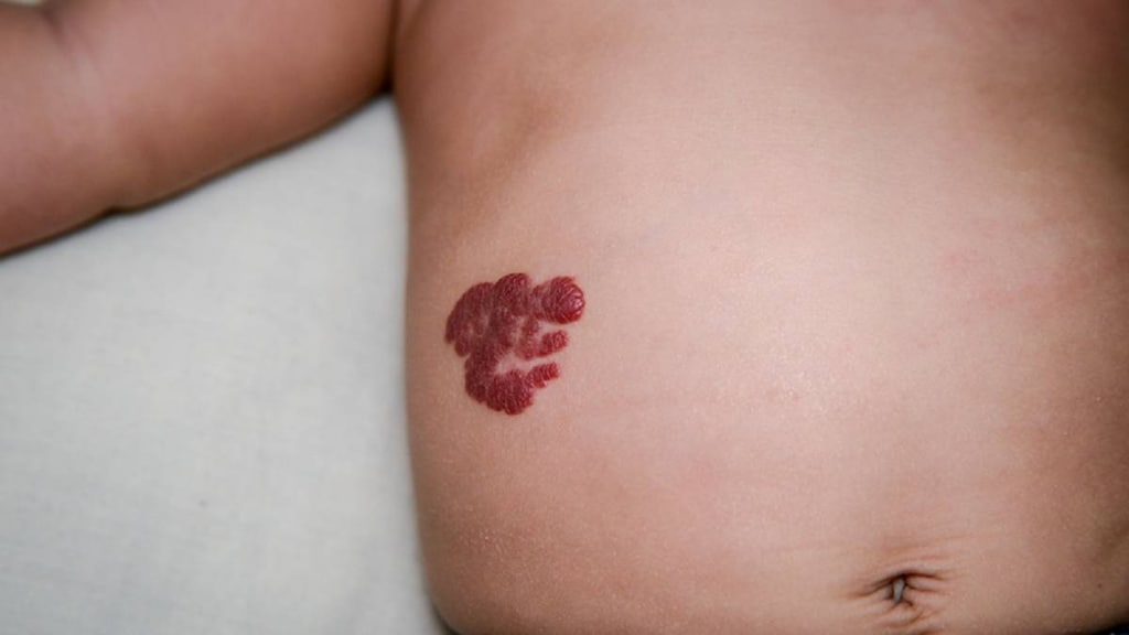 Child with hemangiomas on torso