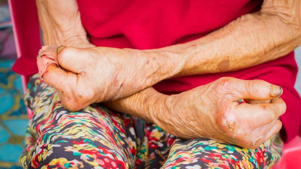 Old womans' hands with some amputation