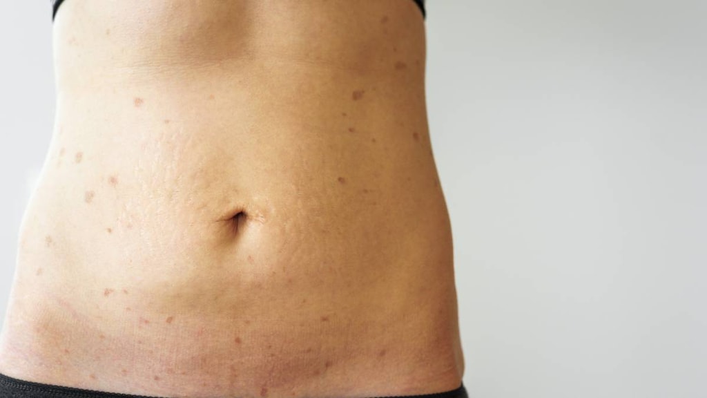 Woman with Lichen Planus on torso