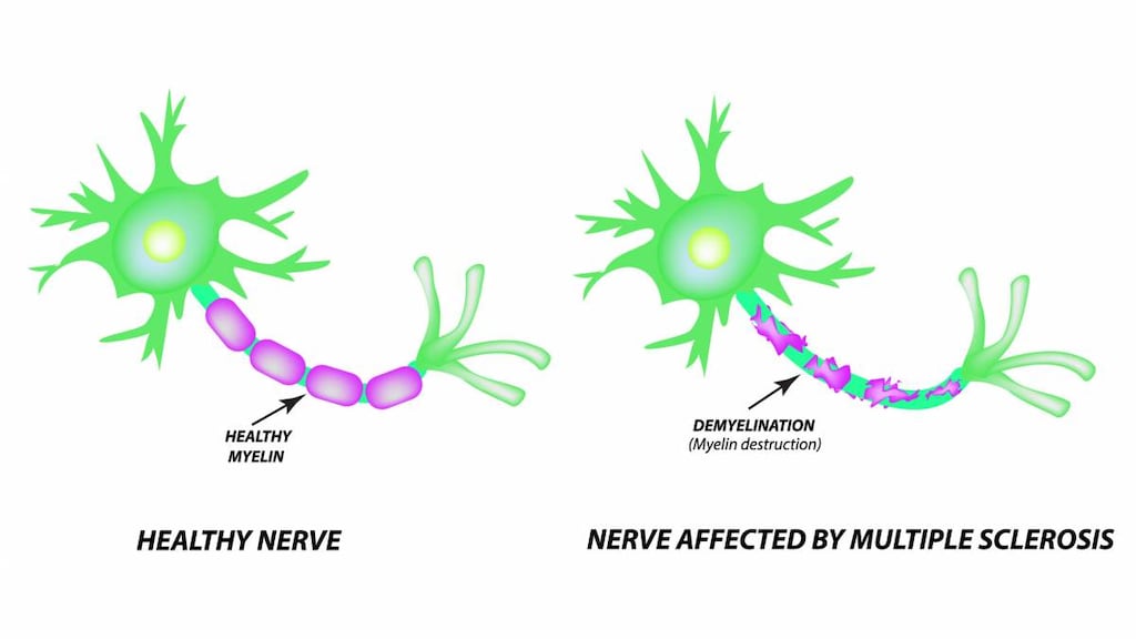 myelin sheath damage