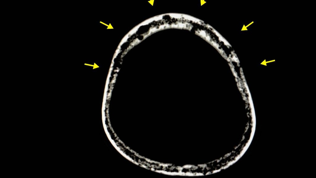 Skull Xray with Multiple Myeloma