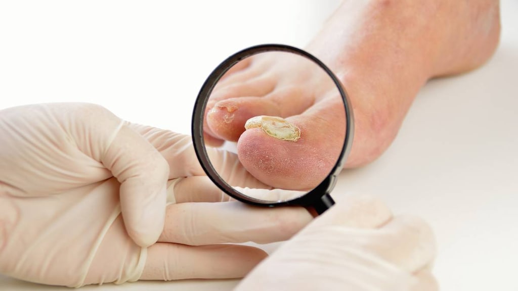Doctor inspecting a big toenail with a fungal infection.