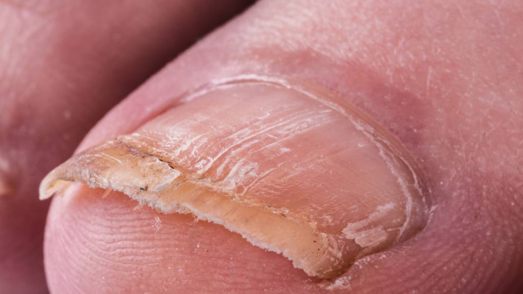 Big toe with nail fungus