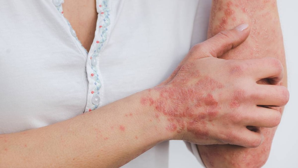 Women with psoriasis on the hand and arm.