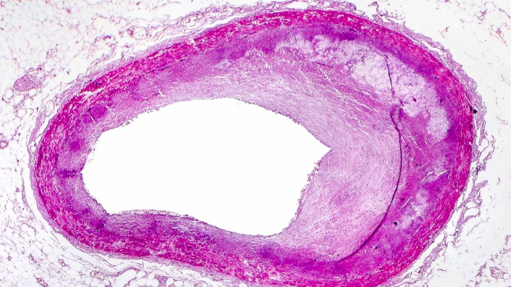 Peripheral Arterial Disease