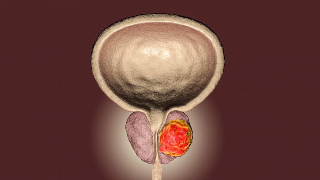 Prostate cancer image.