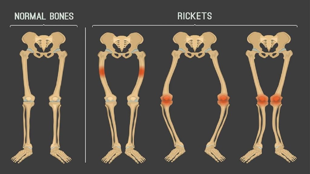 Illustration of Rickets