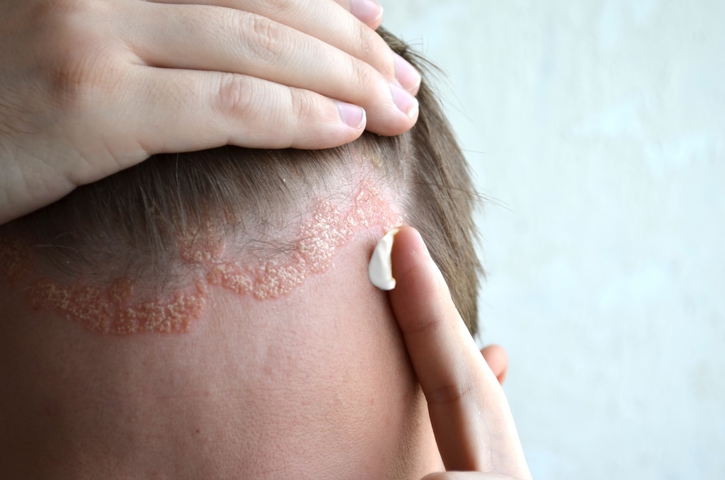 Scalp scabs pikkelysömör kezelése