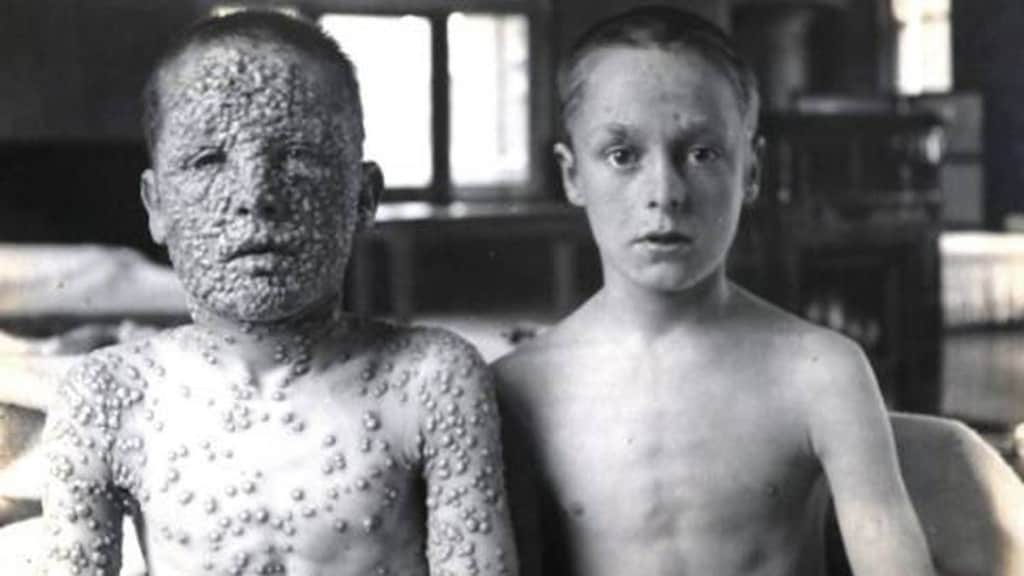 Smallpox: Two boys, one vaccinated, the other not