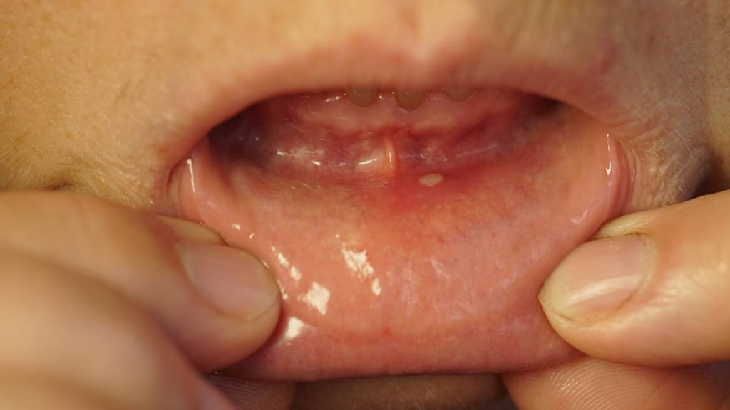 Showing stomatitis on bottom lip