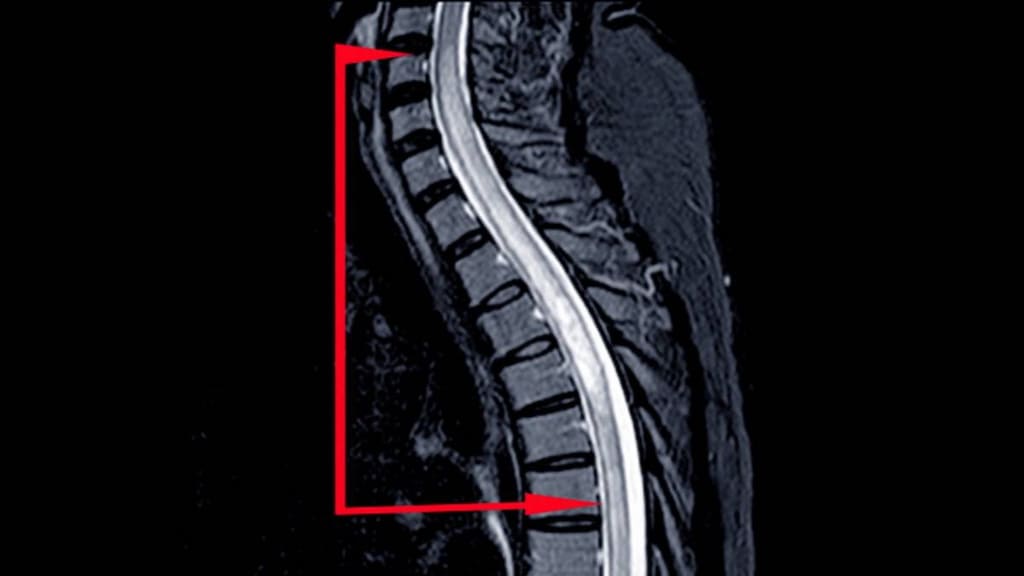 Xray of transverse myelitis