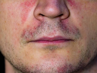 perioralis dermatitis