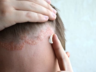 what is the best over the counter medicine for psoriasis?)
