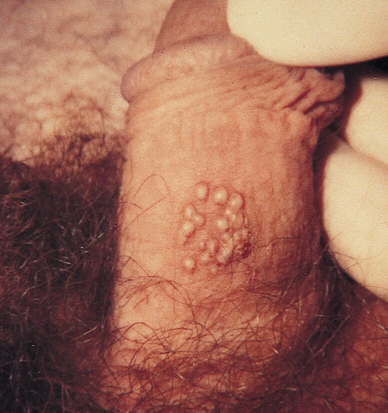 Genital Herpes on the Penis