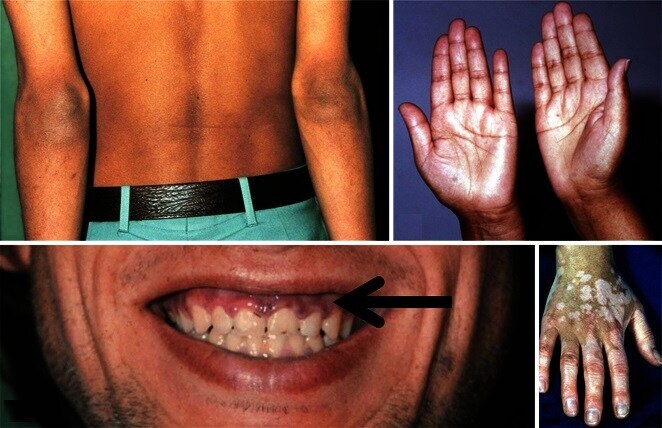 Skin Changes in Addison Disease