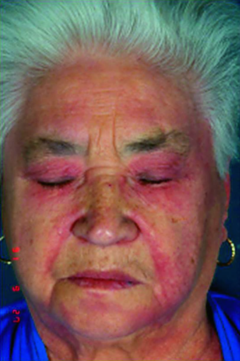 Heliotrope Rash