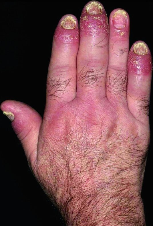 Dactylitis