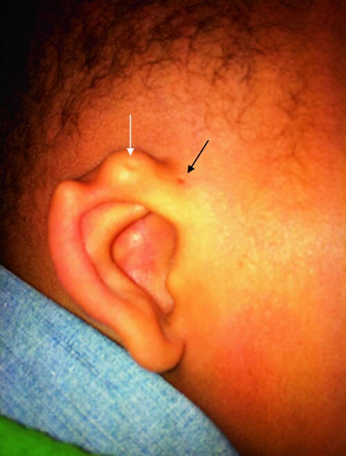 Ear Pits