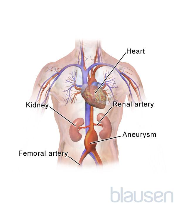 Abdominal Aortic Aneurysm
