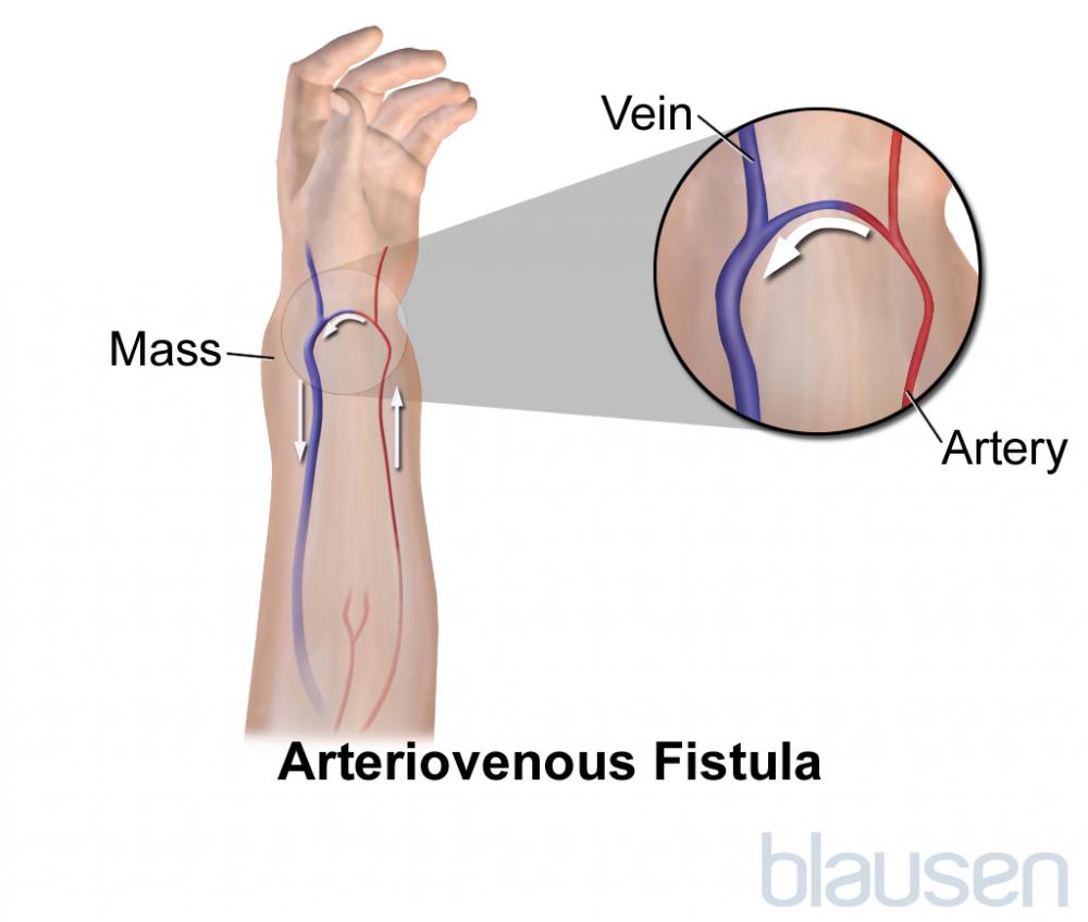 Arteriovenous Fistula