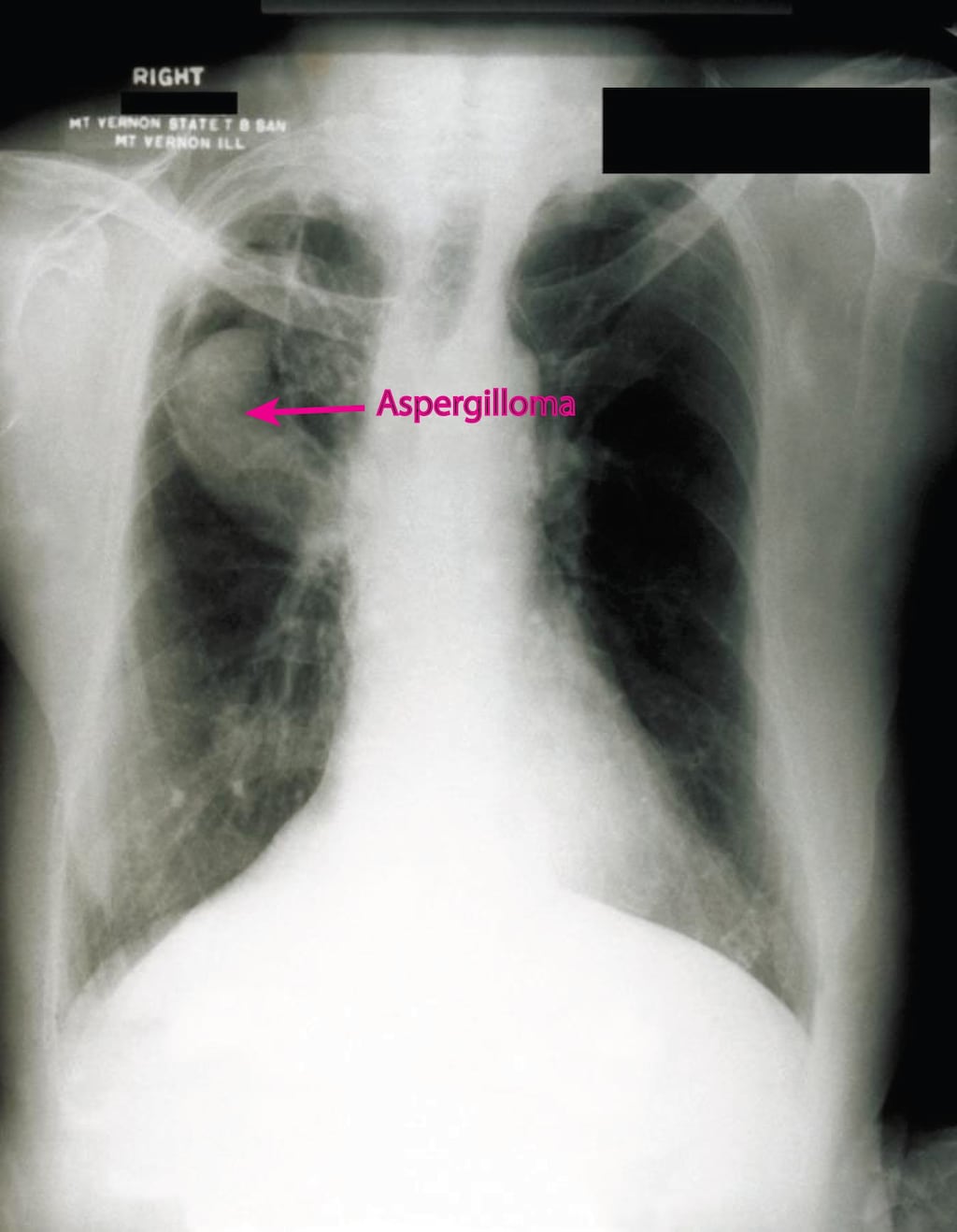 Aspergilloma