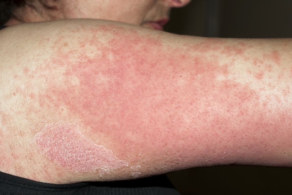 Drug Rashes Skin Disorders