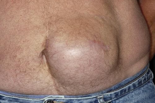 Incisional Hernia