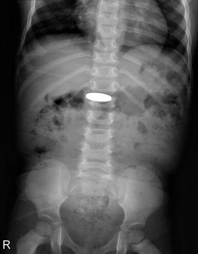 Foreign Body in the Digestive Tract (X-Ray)