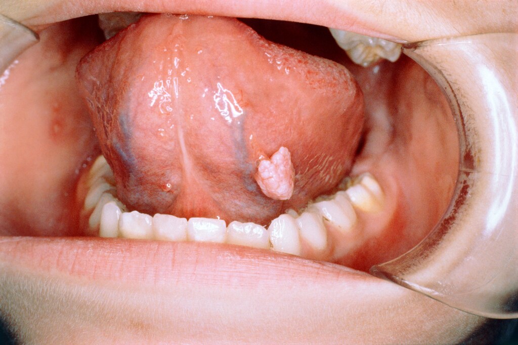 Genital Wart in Mouth