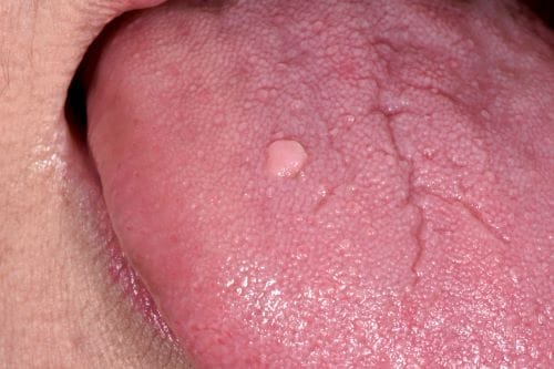 Common Wart in the Mouth