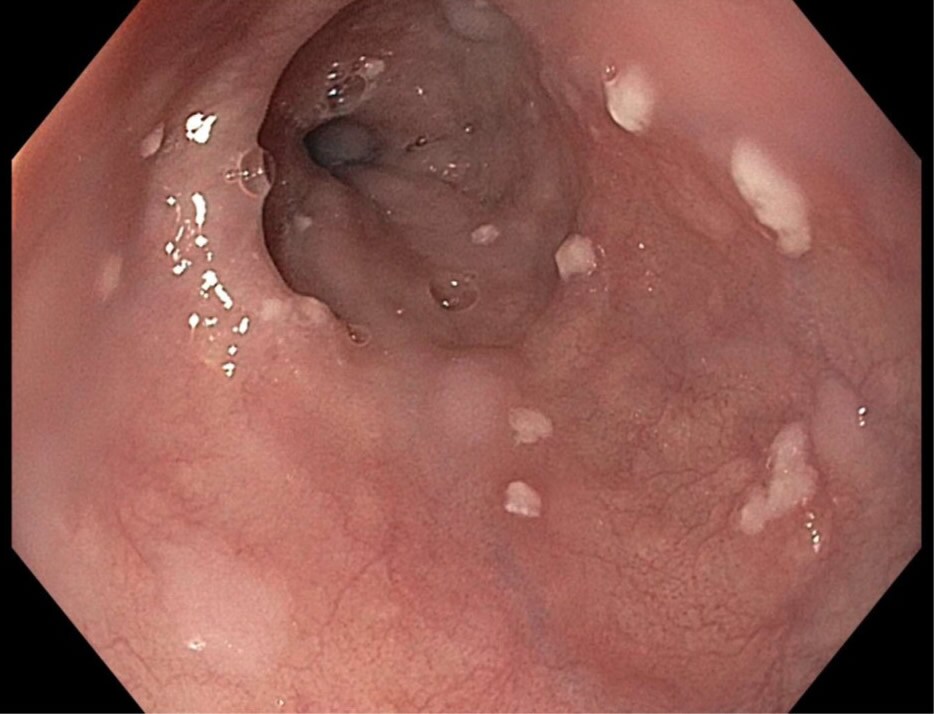 Infection of the Esophagus Caused by Candida